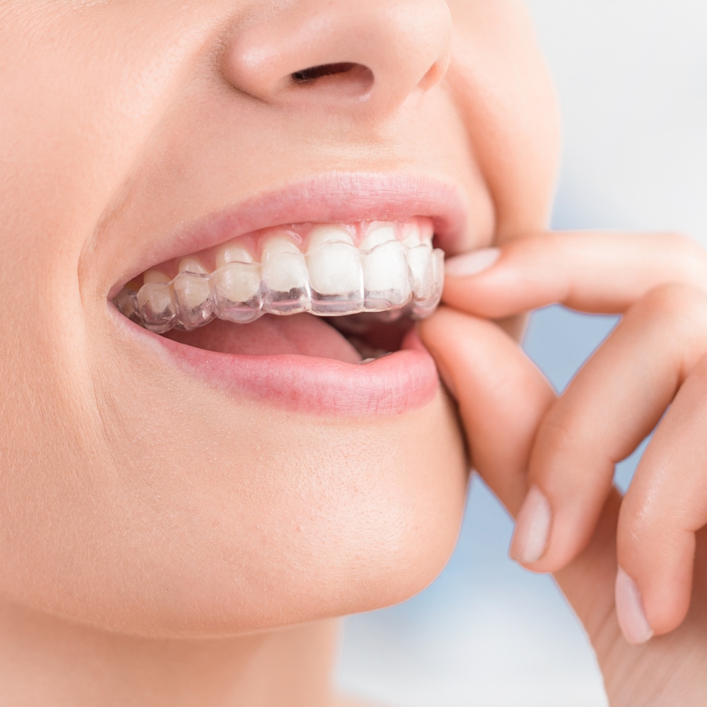 Benefits of Invisalign at White Orchid Dentistry