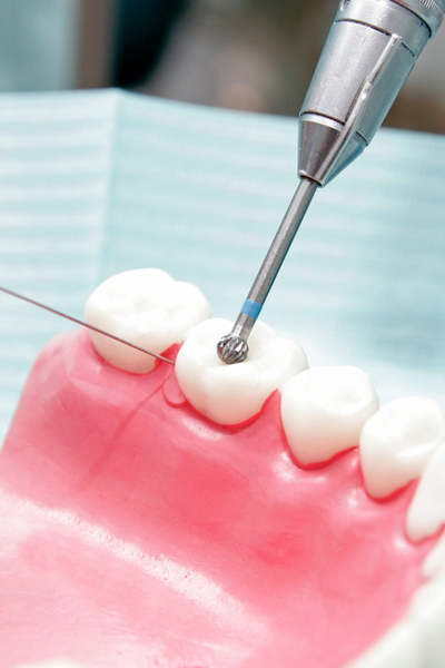 Bond directly to tooth structure, requiring less drilling.