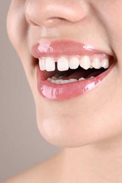 Close gaps between teeth