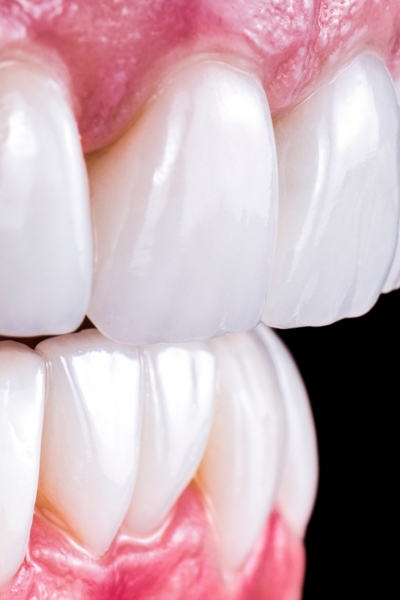 Creating veneers chairside with precision milling technology
