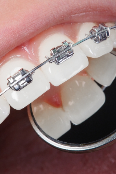 Effective results for mild to moderate orthodontic issues.