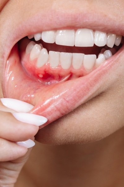 Increased risk of cavities and gum disease.