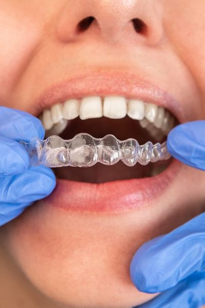 Restoring a broken, cracked, or worn tooth