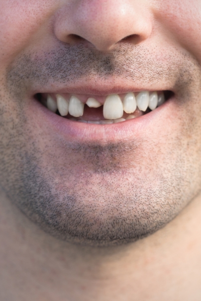 Save damaged or knocked-out teeth if treated quickly