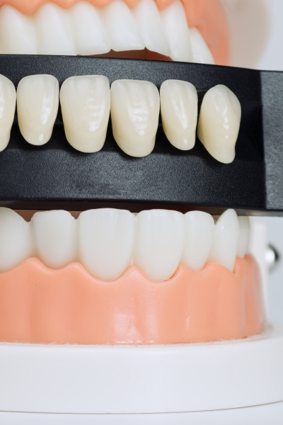 Saving time while avoiding temporary veneers