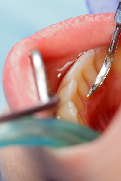 Spread of infection to surrounding tissues