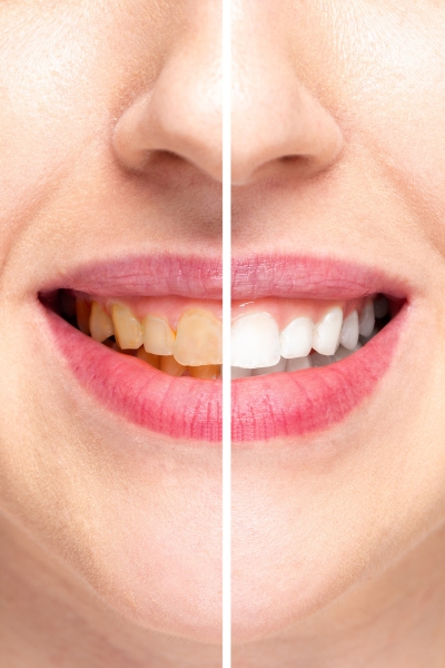 Stronger & faster: Removes deep stains in just one session
