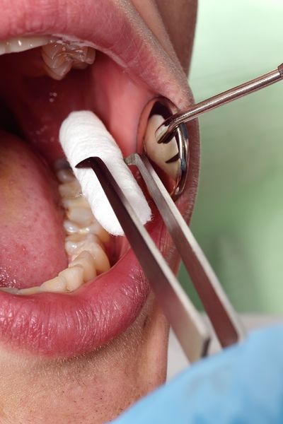 Tooth decay or cavities.