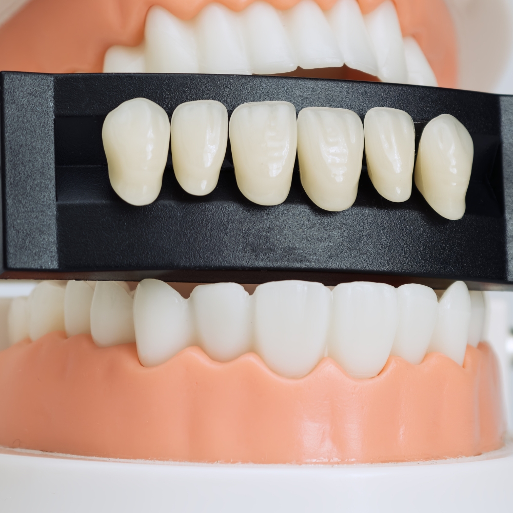 What to Expect During the Same-Day Veneer Procedure