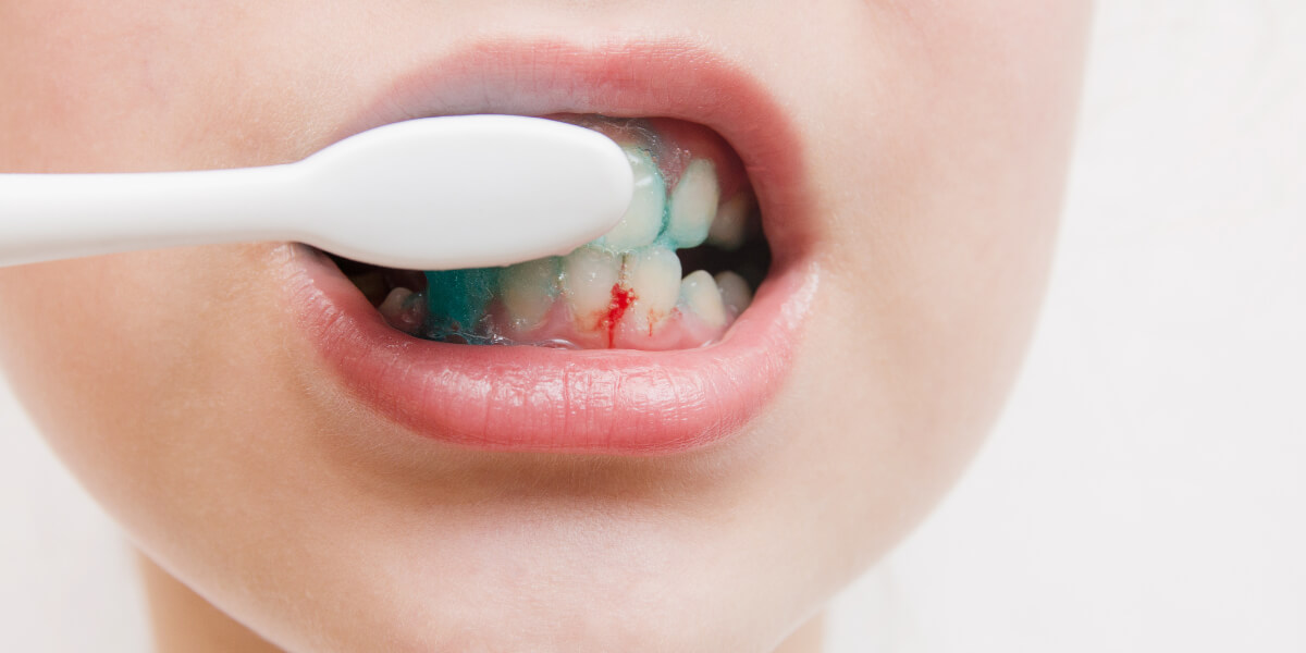 Why Do My Gums Bleed When I Brush? Dentist Explains